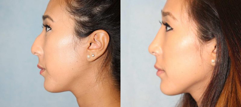 Rhinoplasty Patient 5 Image 0