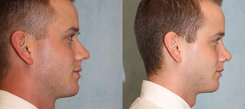 Rhinoplasty Patient 4 Image 1