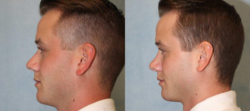 Rhinoplasty Patient 4 Image 0