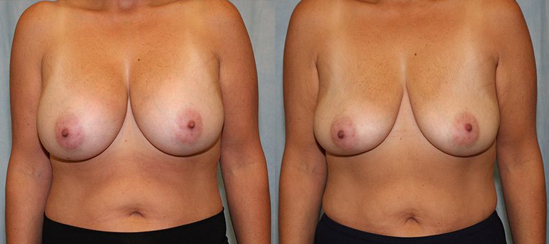 Breast Implant Removal Patient 2 Image 0