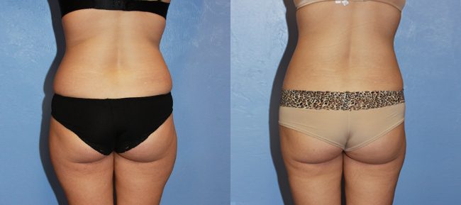 Liposuction Patient 6 Image 2