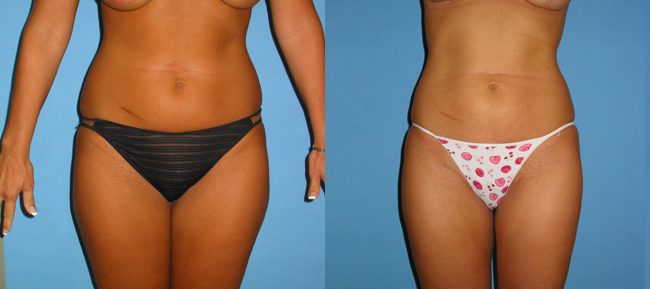 Liposuction Patient 5 Image 3