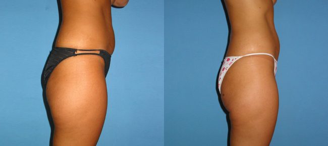 Liposuction Patient 5 Image 2