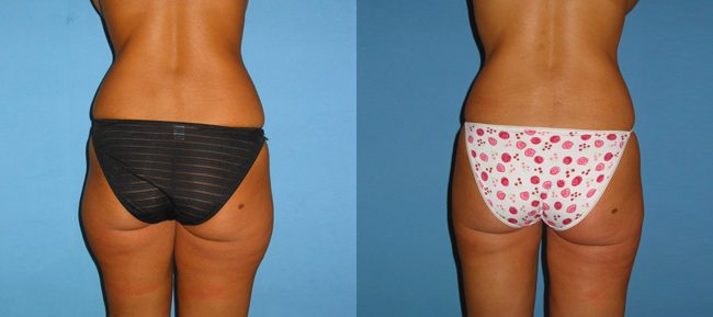 Liposuction Patient 5 Image 1