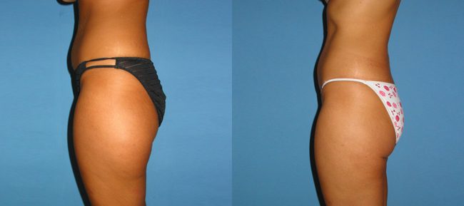 Liposuction Patient 5 Image 0