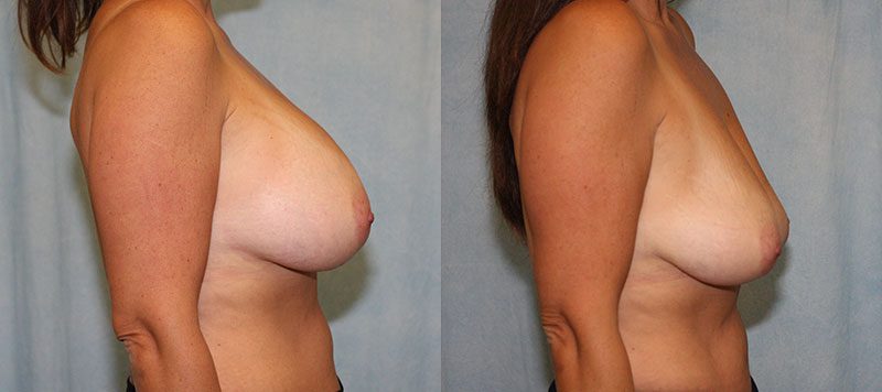 Breast Implant Removal Patient 2 Image 2