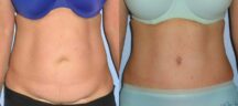 Mini Tummy Tuck Before and After Photo 2