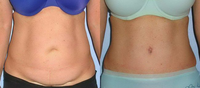 Post-Partum Belly Repair (Tummy Tucks) - Explore Plastic Surgery