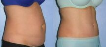 Mini Tummy Tuck Before and After Photo 1