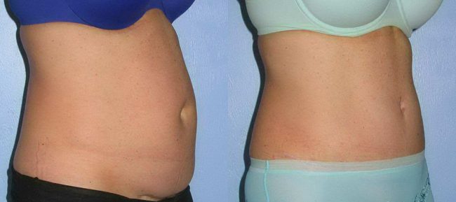 Abdominoplasty Patient 14 Image 1