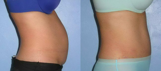 Abdominoplasty Patient 14 Image 5