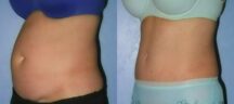 Mini Tummy Tuck Before and After Photo 0