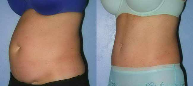 Abdominoplasty Patient 14 Image 2