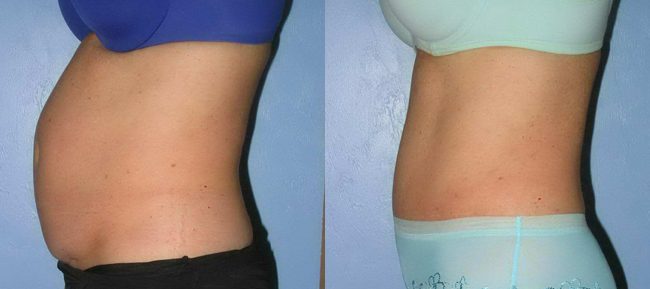 Abdominoplasty Patient 14 Image 3