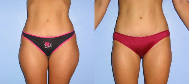 Liposuction Patient 4 Image 3