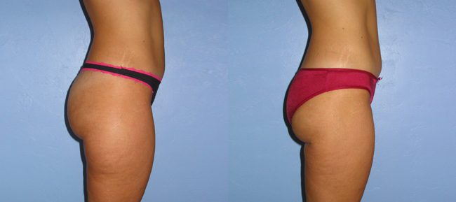 Liposuction Patient 4 Image 2