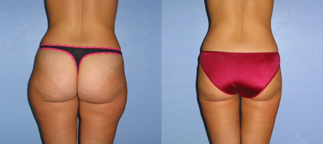 Liposuction Patient 4 Image 1