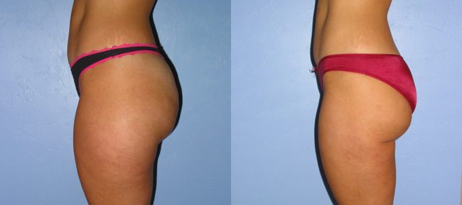 Liposuction Patient 4 Image 0