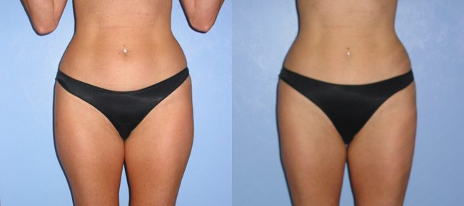 Liposuction Patient 3 Image 6