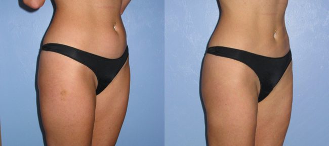 Liposuction Patient 3 Image 5