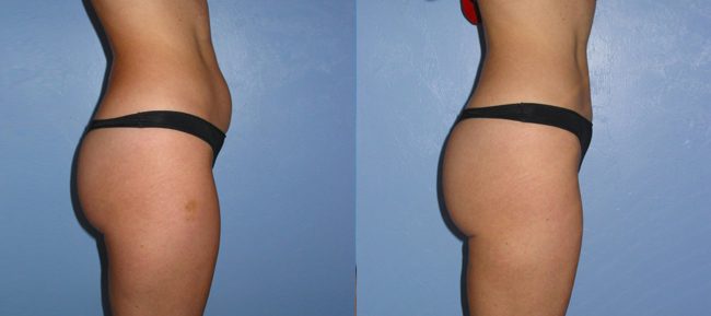 Liposuction Patient 3 Image 4