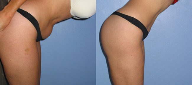 Liposuction Patient 3 Image 3