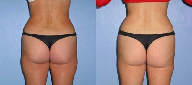 Liposuction Patient 3 Image 2