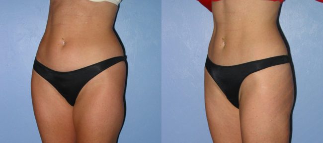 Liposuction Patient 3 Image 0