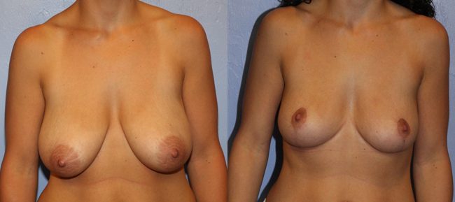 Breast Lift Patient 7 Image 4