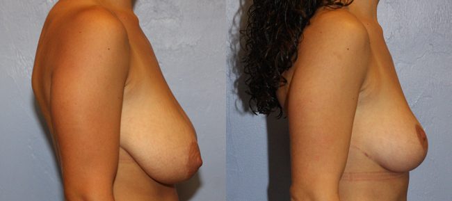 Breast Lift Patient 7 Image 2