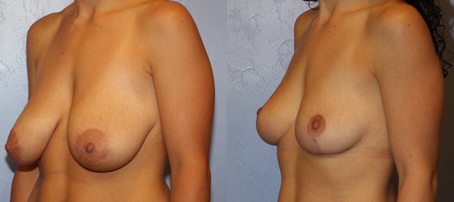 Breast Lift Patient 7 Image 1