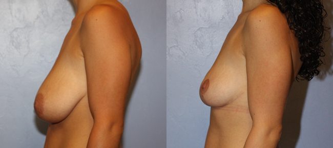 Breast Lift Patient 7 Image 0