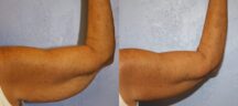Brachioplasty Before and After Photo 1