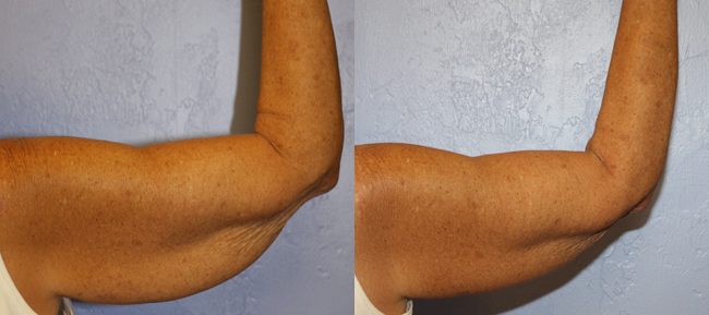 Brachioplasty Before and After Photo 1