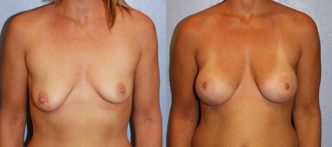 Breast Lift Patient 6 Image 4