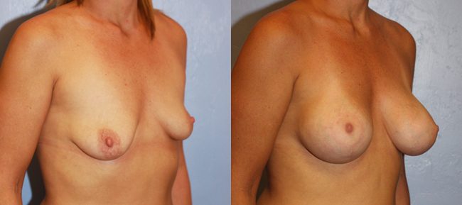 Breast Lift Patient 6 Image 3