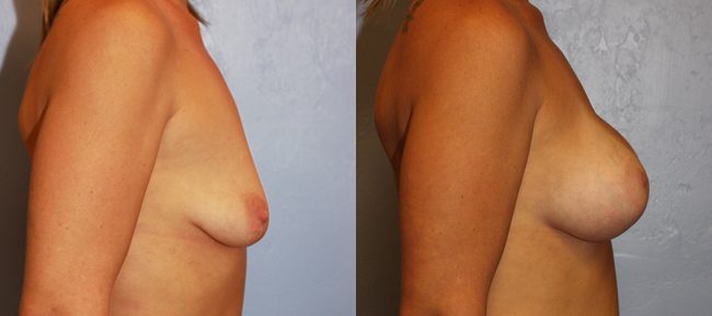 Breast Lift Patient 6 Image 2