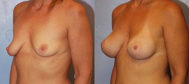 Breast Lift Patient 6 Image 1