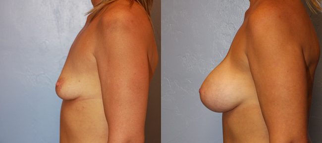 Breast Lift Patient 6 Image 0