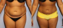 Liposuction Before and After Photo 0