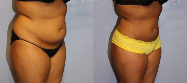 Liposuction Patient 2 Image 3