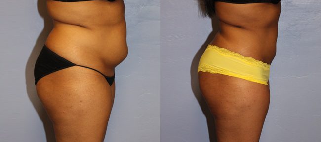 Liposuction Patient 2 Image 2