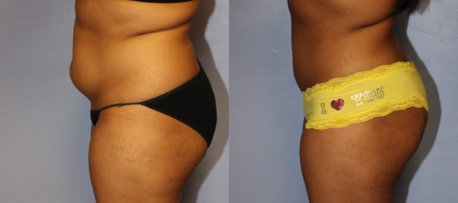 Liposuction Patient 2 Image 1