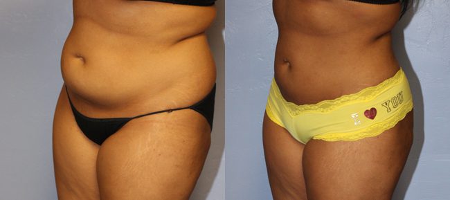 Liposuction Patient 2 Image 0