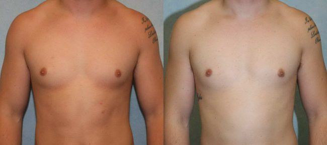 Male Gynecomastia Patient 2 Image 4