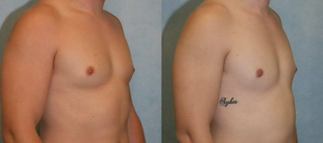 Male Gynecomastia Patient 2 Image 3