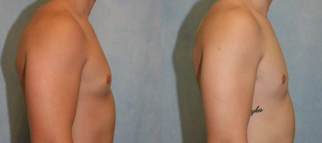 Male Gynecomastia Patient 2 Image 2