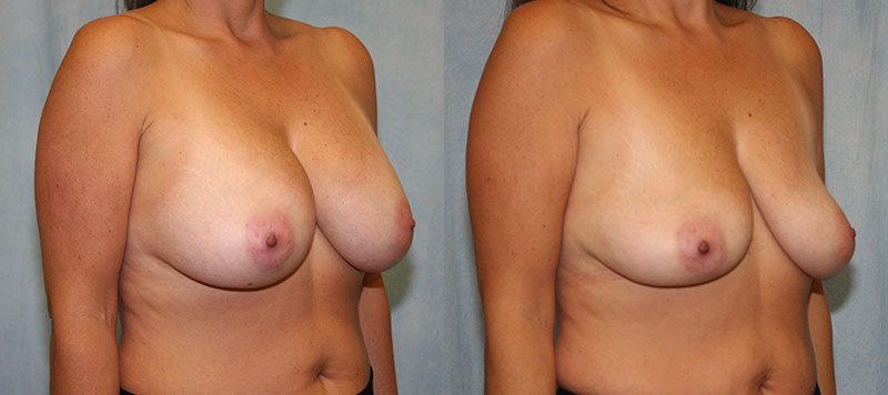 Breast Implant Removal Patient 2 Image 3
