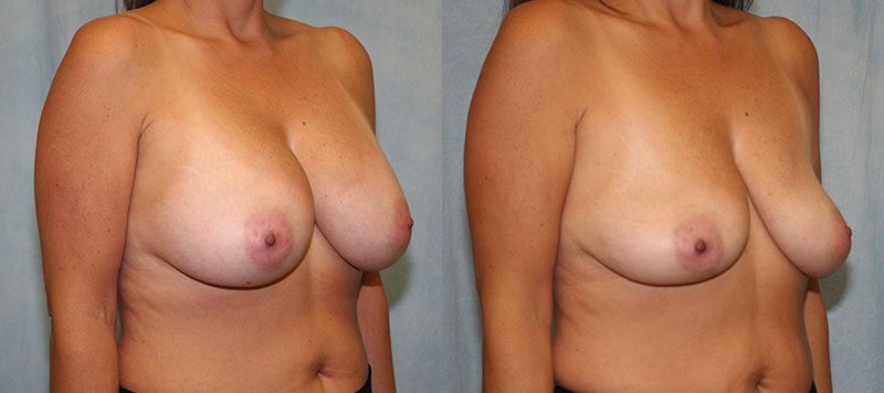 Breast Implant Removal Patient 2 Image 2