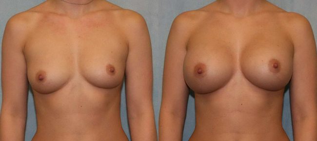 Breast Augmentation Patient 10 Image 4